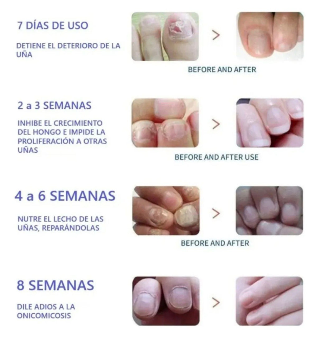Parches para hongos y cuidado de las uñas + Regalo